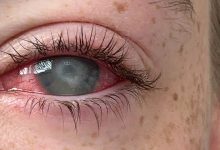 A blinding parasitic eye disease affects mostly contact lens wearers. Here’s how to avoid it