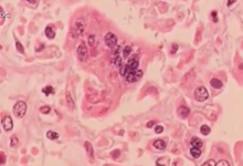 57 cases of measles confirmed at Ave Maria University, 7 currently contagious