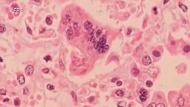 57 cases of measles confirmed at Ave Maria University, 7 currently contagious