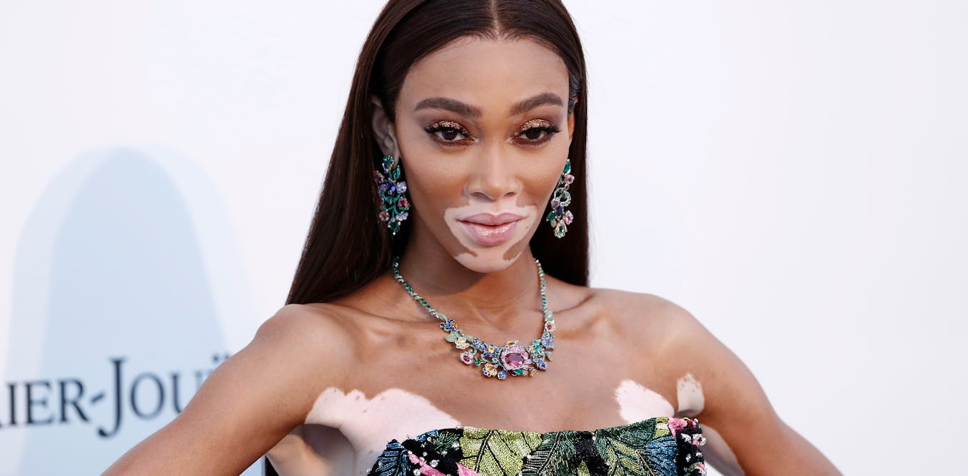 Vitiligo affects around 1 in 100 people worldwide – yet the skin condition remains misunderstood